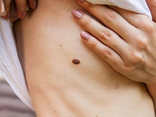 skin tag 5.jpg