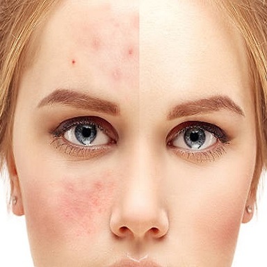 laser acne treatment (2).jpg