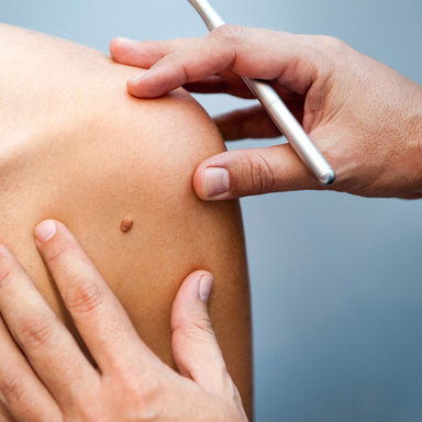 skin tag2.jpg