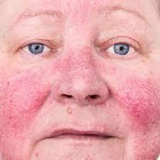 actinic6.jpg