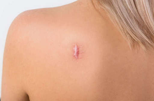 keloid 2.jpg