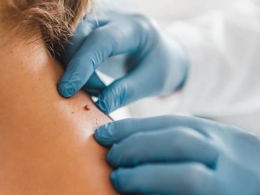 skin tag3.jpg