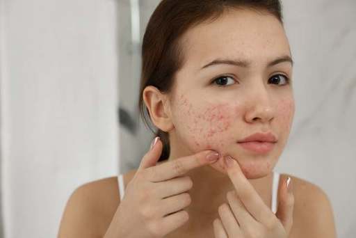 Acne3.jpg