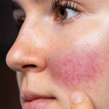 Rosacea2.jpg